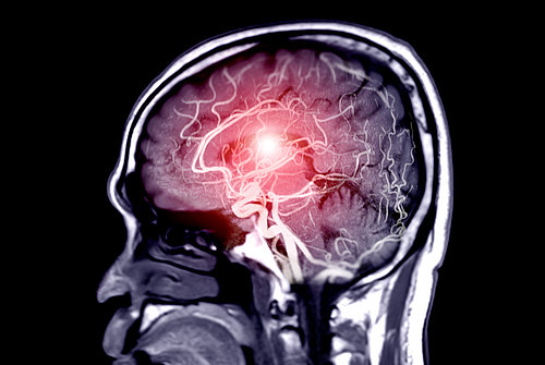 Aneurysmen bleiben häufig unentdeckt, dabei haben schätzungsweise zwei bis fünf Prozent der Bevölkerung eine Gefäßaufweitung im Gehirn. Foto: ©iStock.com/mr.suphachai praserdumrongchai